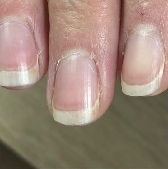 Naturnägel vor der Behandlung, mit eingerissener Nagelhaut